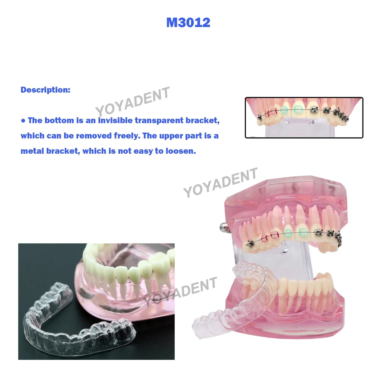 Clear Aligner vs Braces Comparison Teaching Model