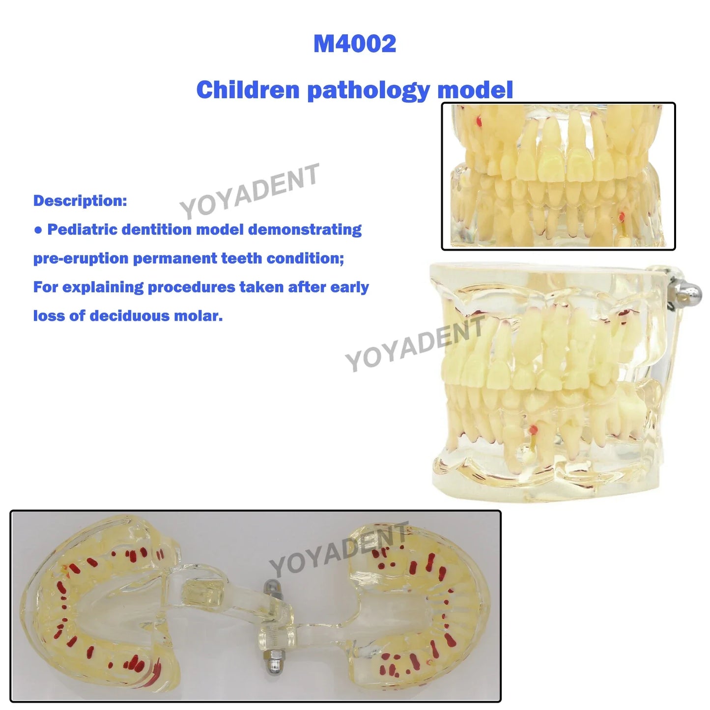 Clear Pediatric Mixed-Dentition Model