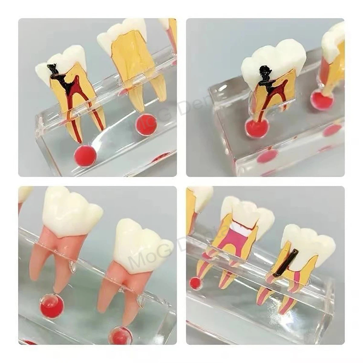 Root Canal Anatomy Teaching Model
