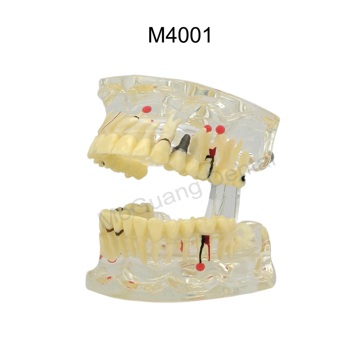 Dental Teeth Model Implant with Removable Dental Education Model for Dentistry Laboratory Demo Studying Dentistry Products Tool