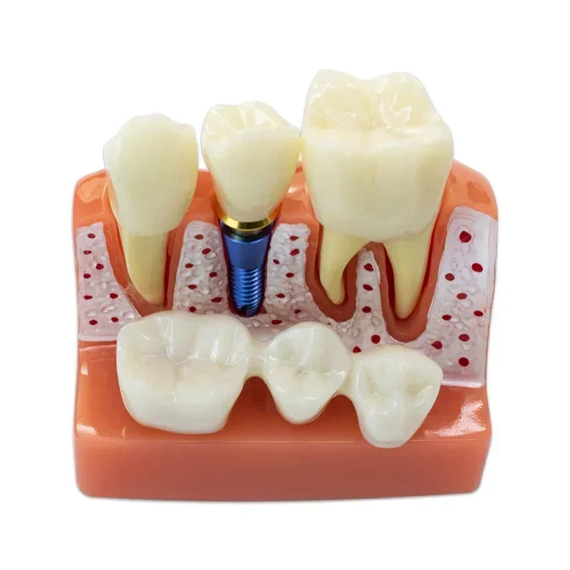 Magnified Caries & Implant Demonstration Model