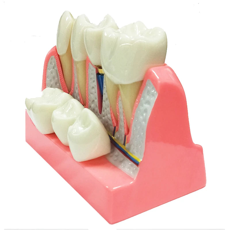 Magnified Caries & Implant Demonstration Model