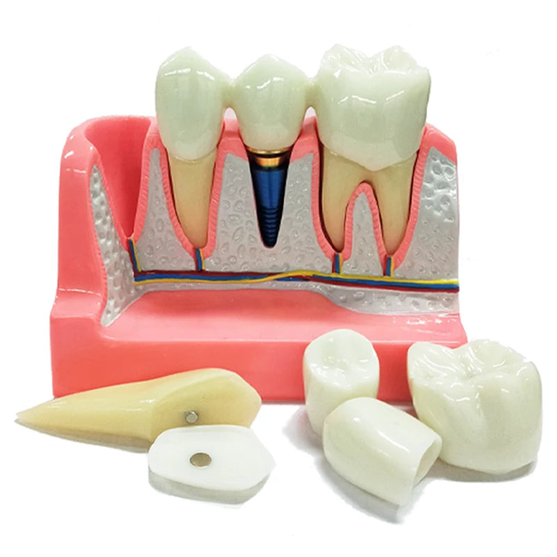 Magnified Caries & Implant Demonstration Model