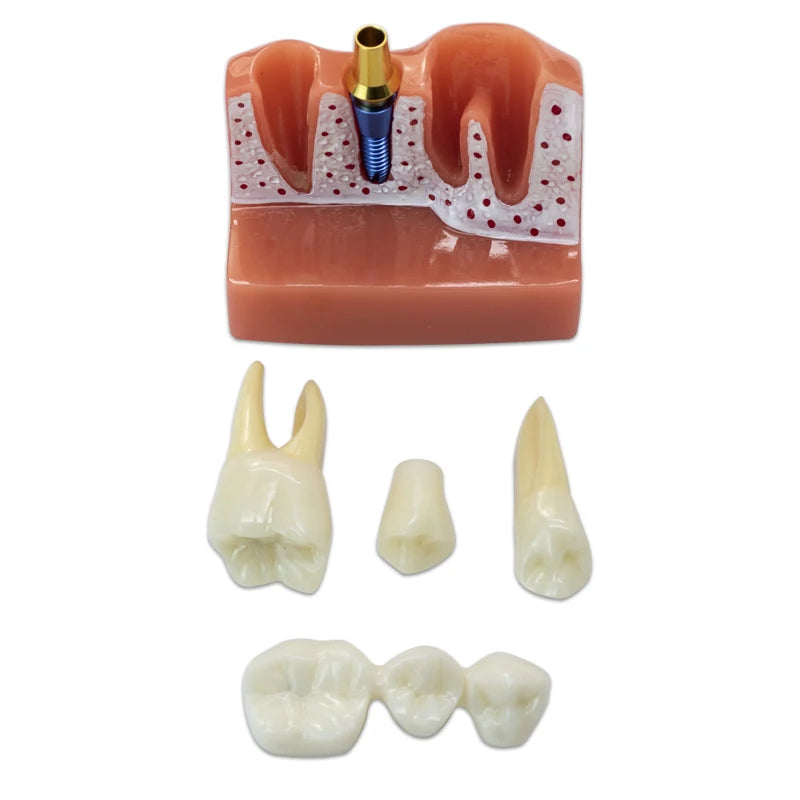 Magnified Caries & Implant Demonstration Model