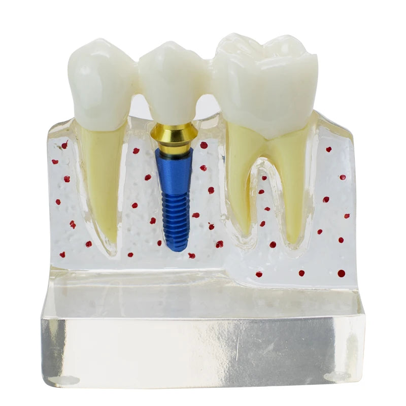 Magnified Caries & Implant Demonstration Model