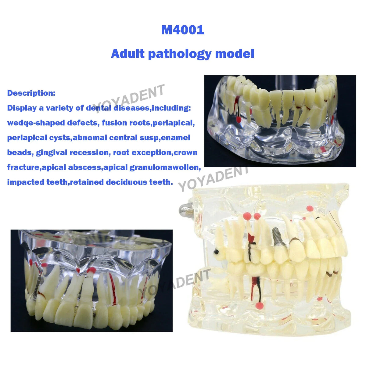 Transparent Dental Pathology Demonstration Model