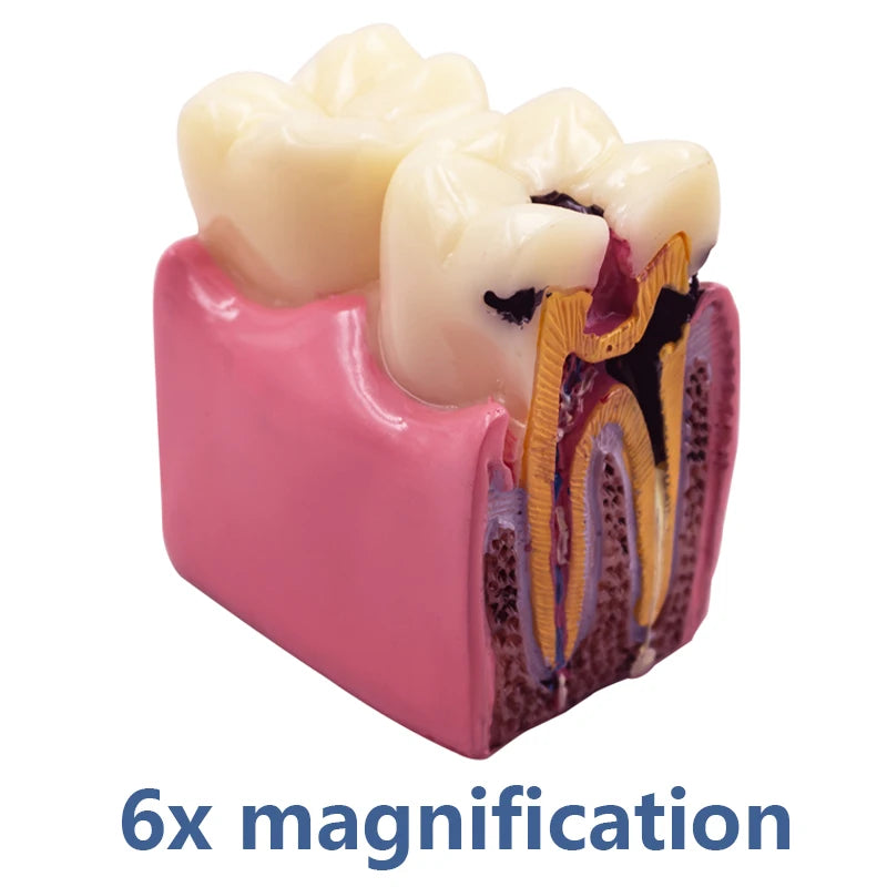 Magnified Caries & Implant Demonstration Model