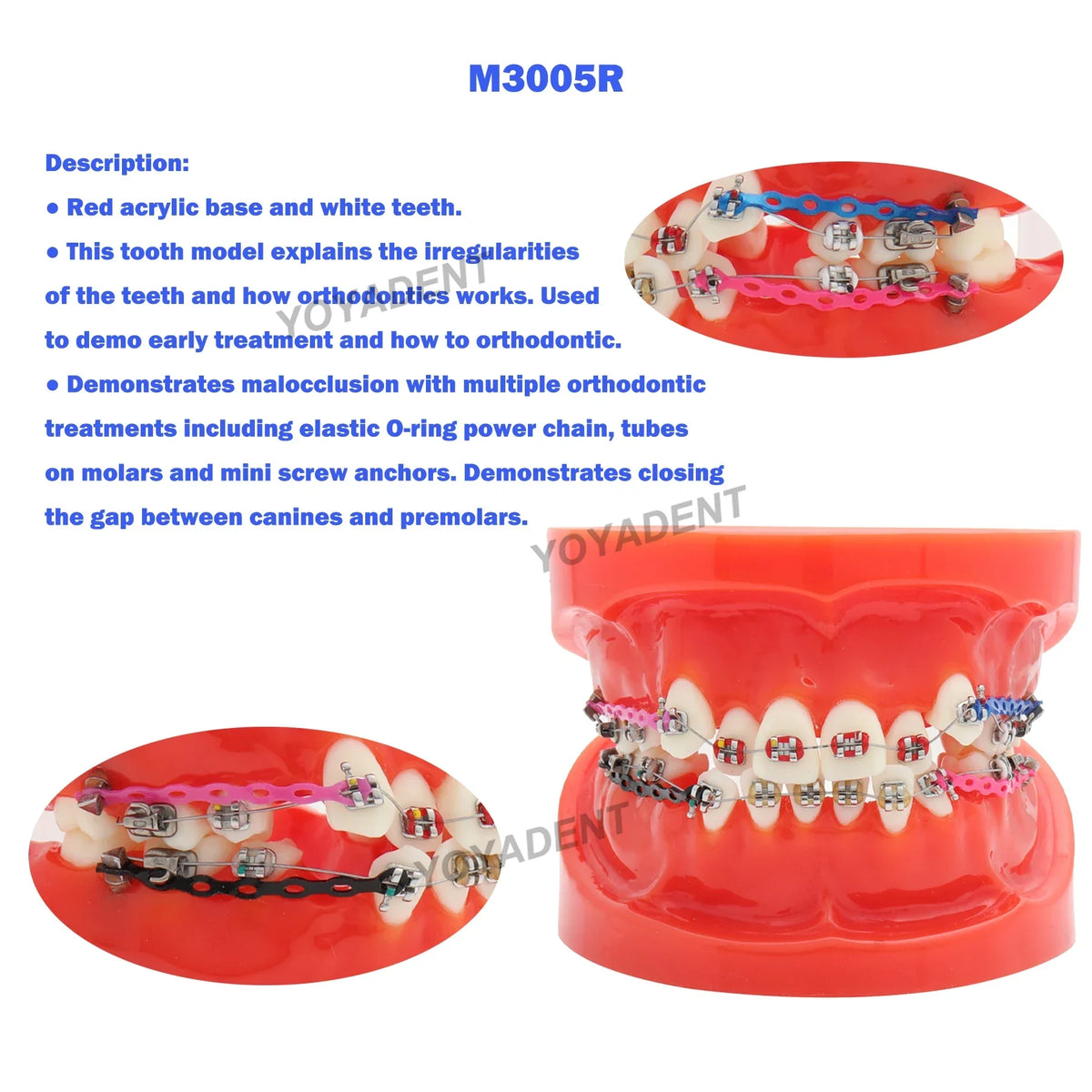 Orthodontic Malocclusion Demonstration Model