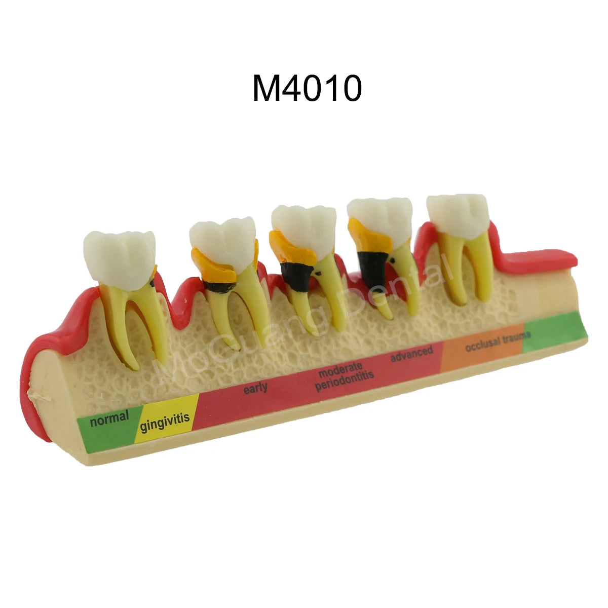 Dental Teeth Model Implant with Removable Dental Education Model for Dentistry Laboratory Demo Studying Dentistry Products Tool