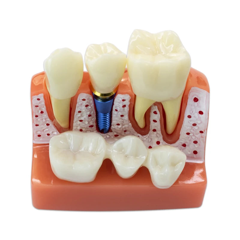 Magnified Caries & Implant Demonstration Model