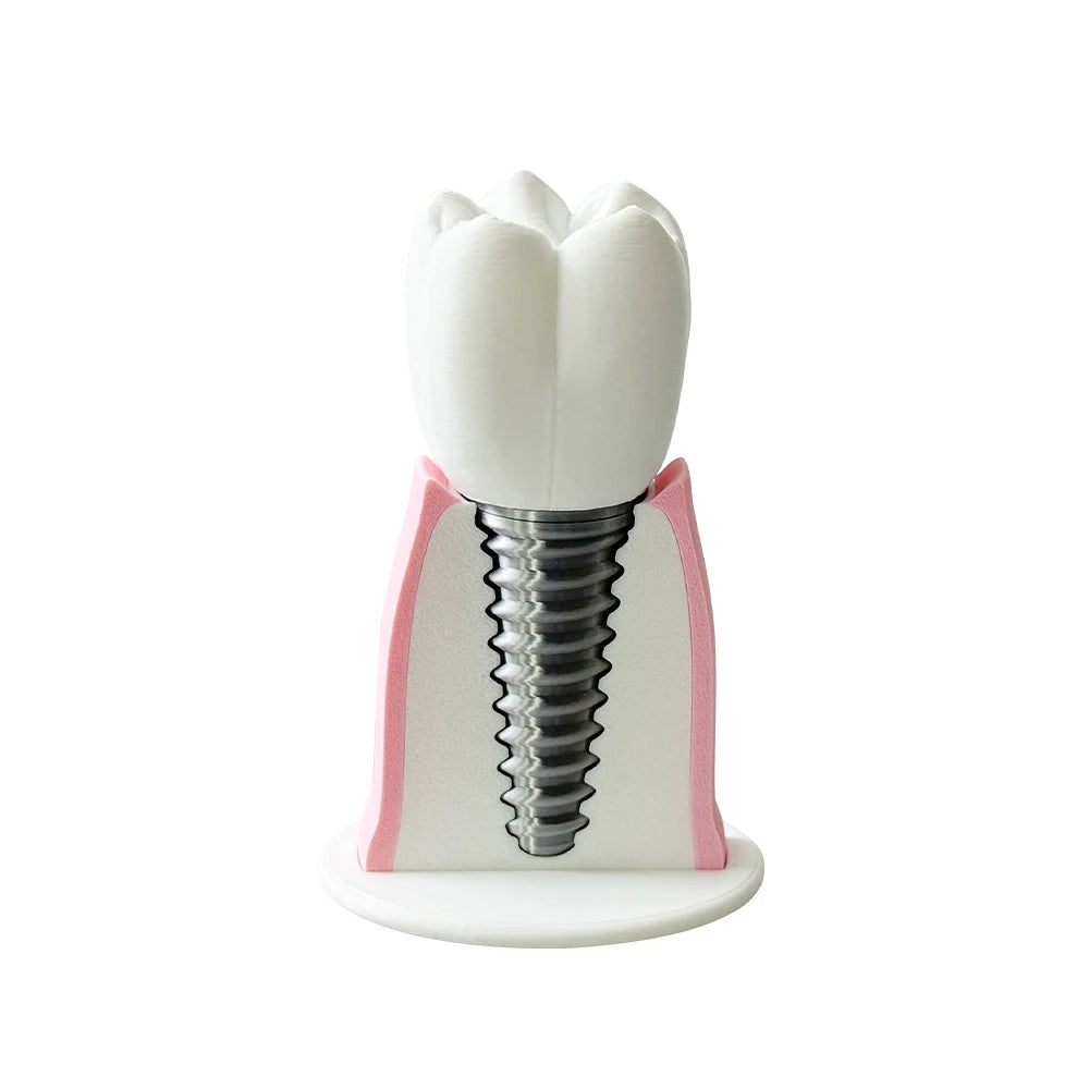 Detachable Implant Demonstration Model (Large)