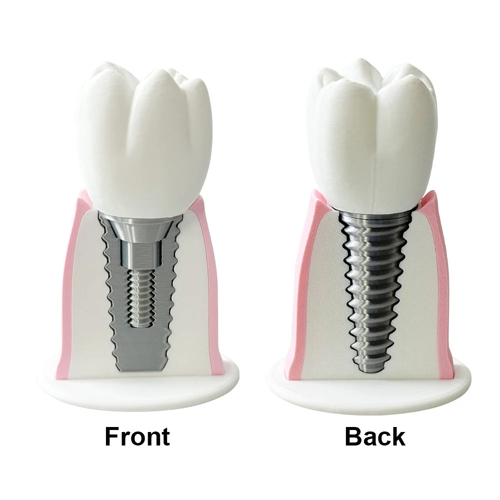 Detachable Implant Demonstration Model (Large)