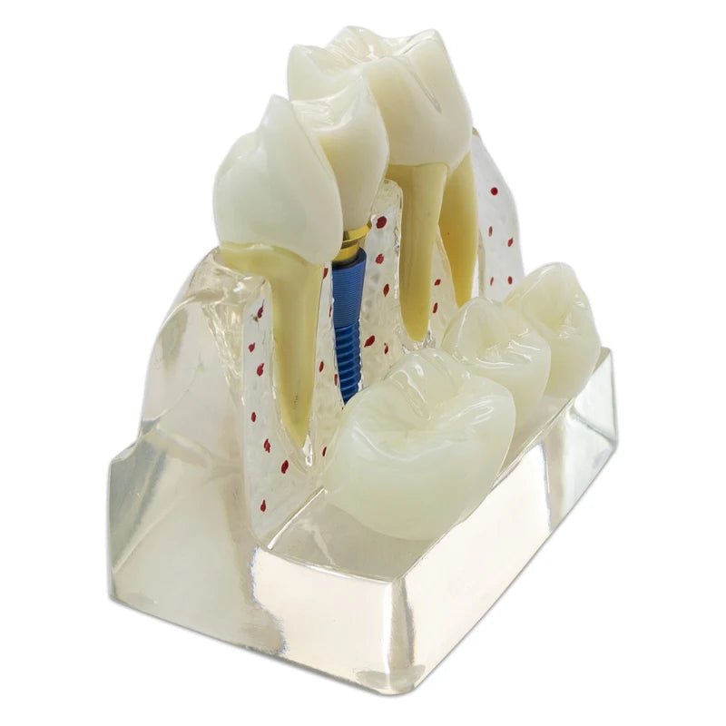 Magnified Caries & Implant Demonstration Model