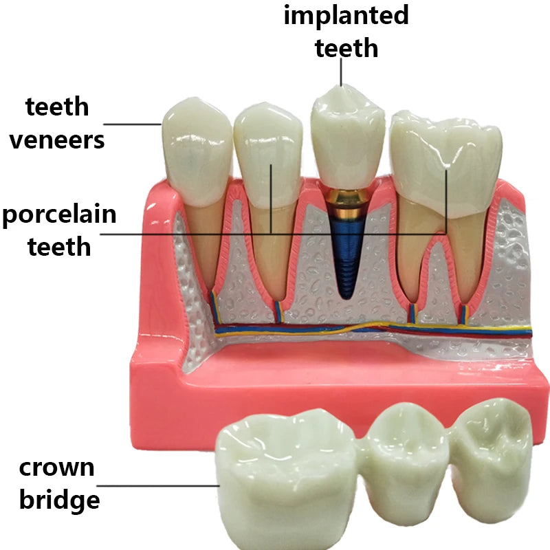 Magnified Caries & Implant Demonstration Model