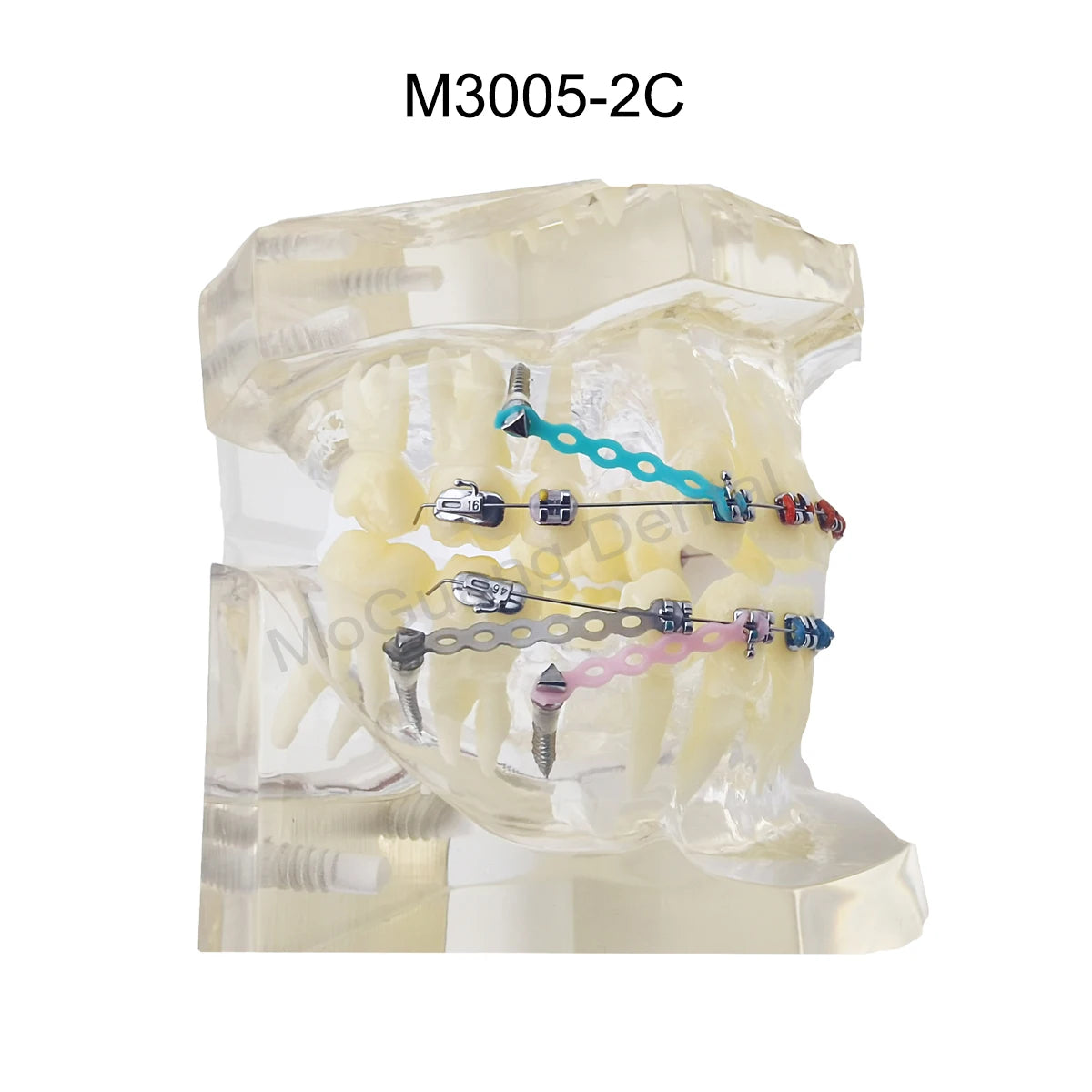 Dental Teeth Model Implant with Removable Dental Education Model for Dentistry Laboratory Demo Studying Dentistry Products Tool