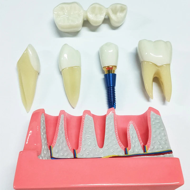 Magnified Caries & Implant Demonstration Model