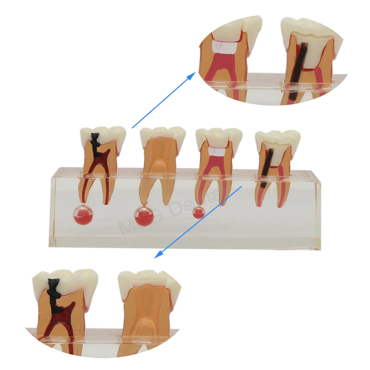 Root Canal Anatomy Teaching Model