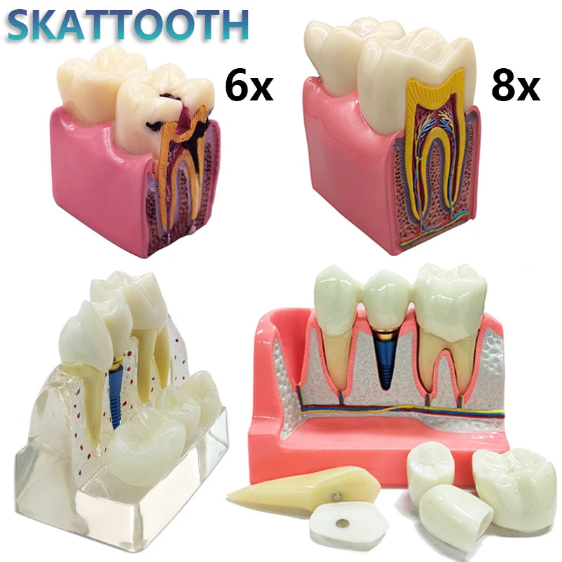 Magnified Caries & Implant Demonstration Model