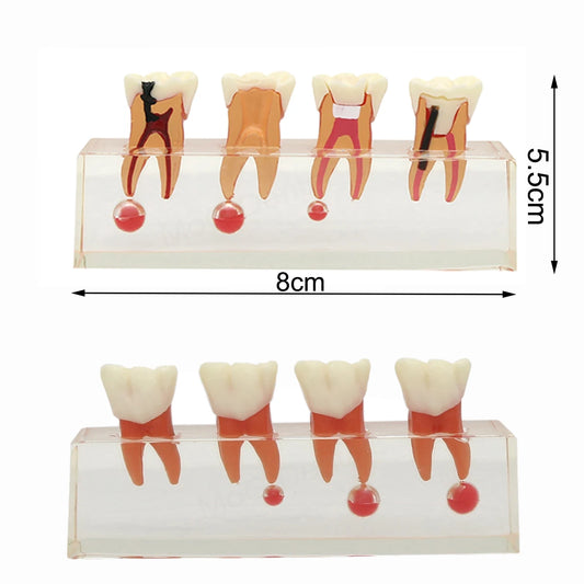 Root Canal Anatomy Teaching Model