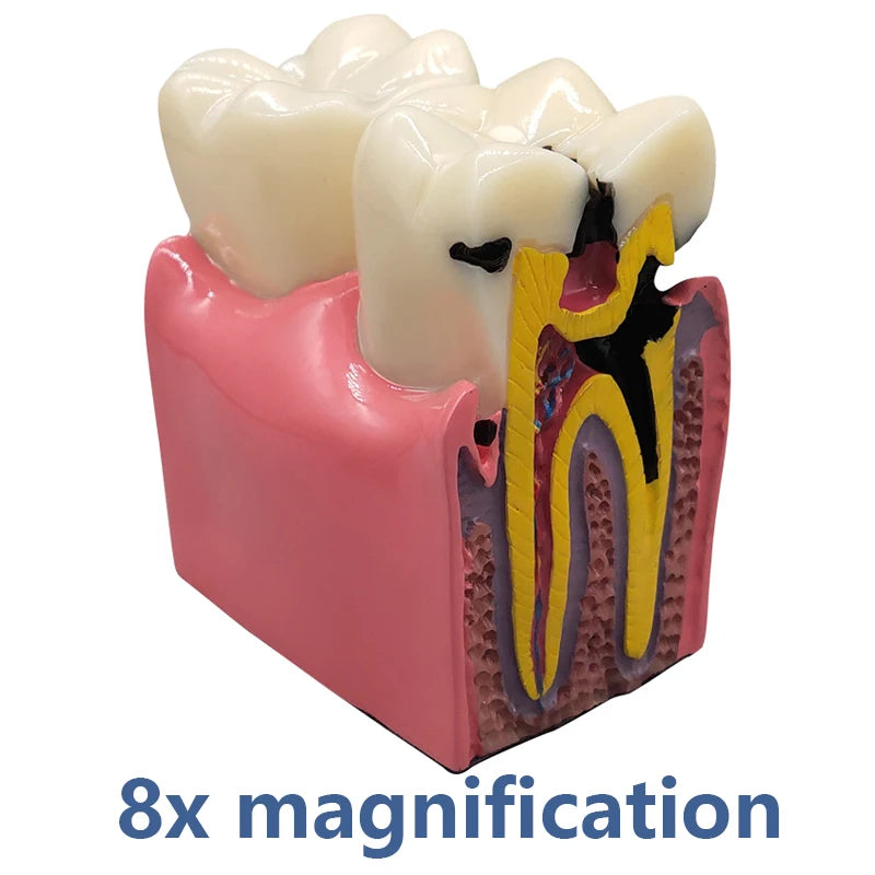 Magnified Caries & Implant Demonstration Model