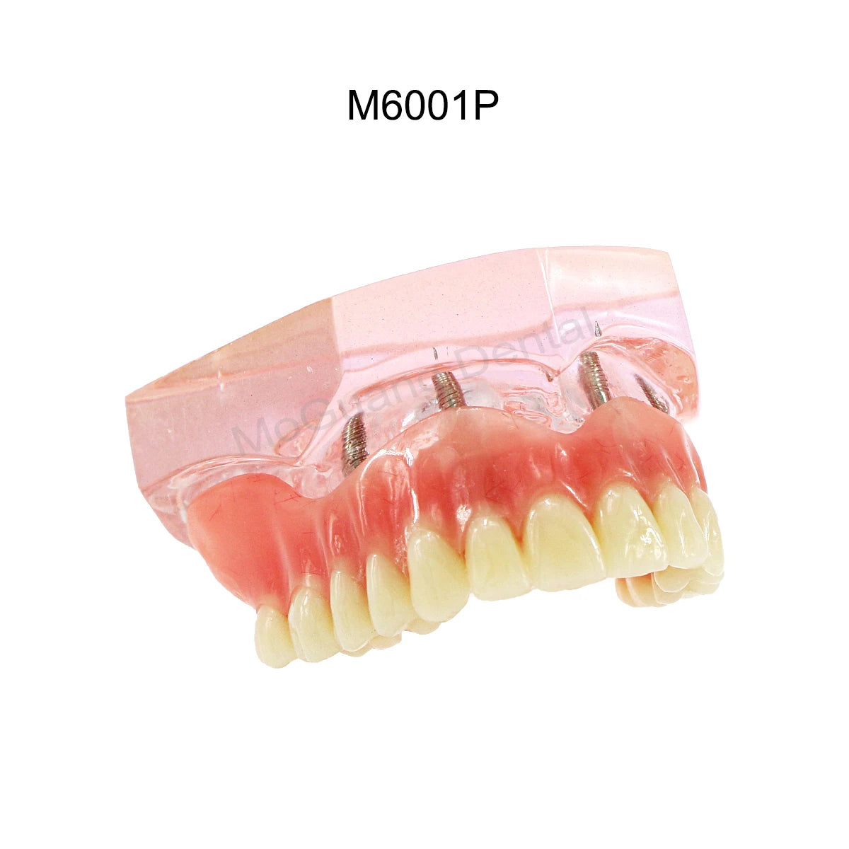 Dental Teeth Model Implant with Removable Dental Education Model for Dentistry Laboratory Demo Studying Dentistry Products Tool