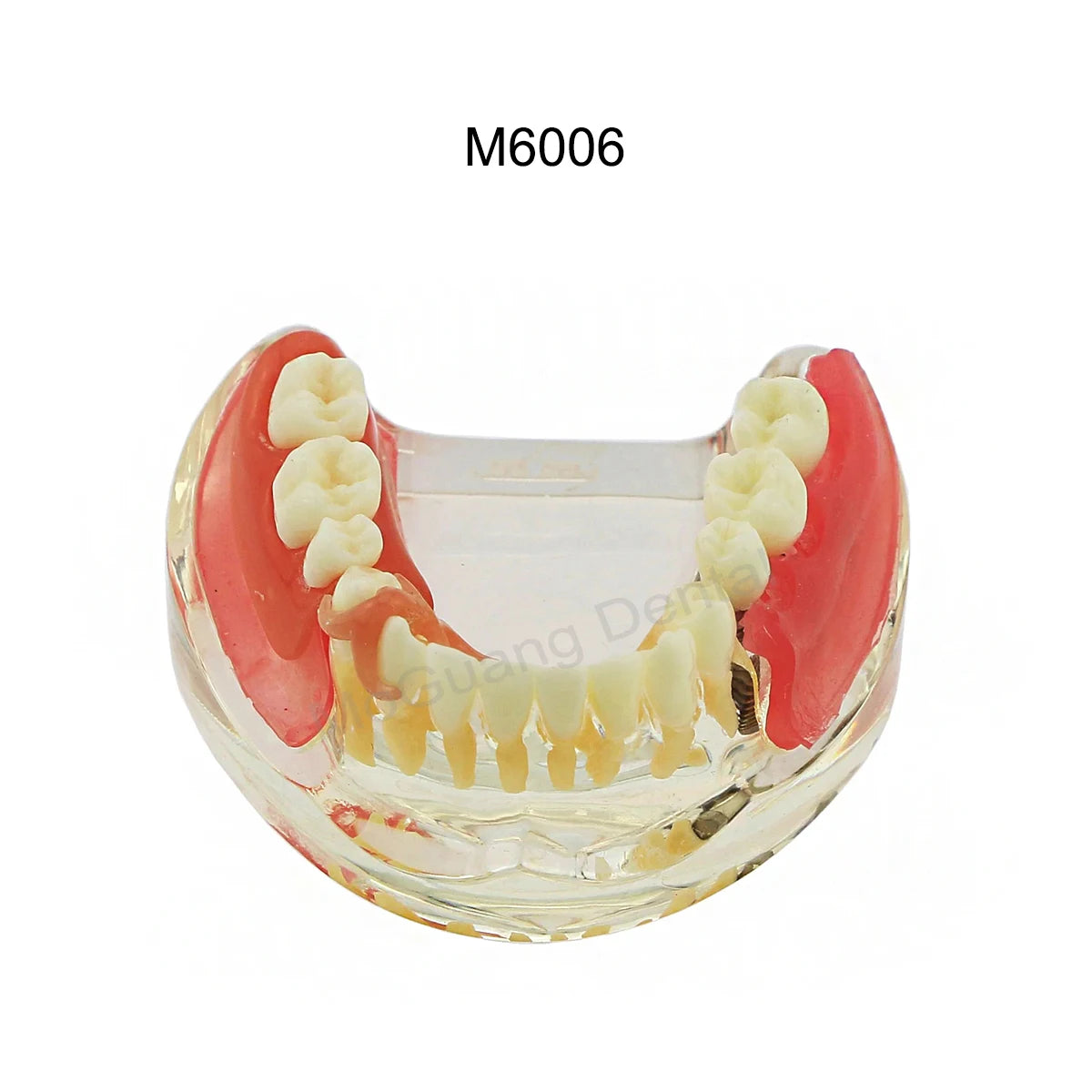Dental Teeth Model Implant with Removable Dental Education Model for Dentistry Laboratory Demo Studying Dentistry Products Tool