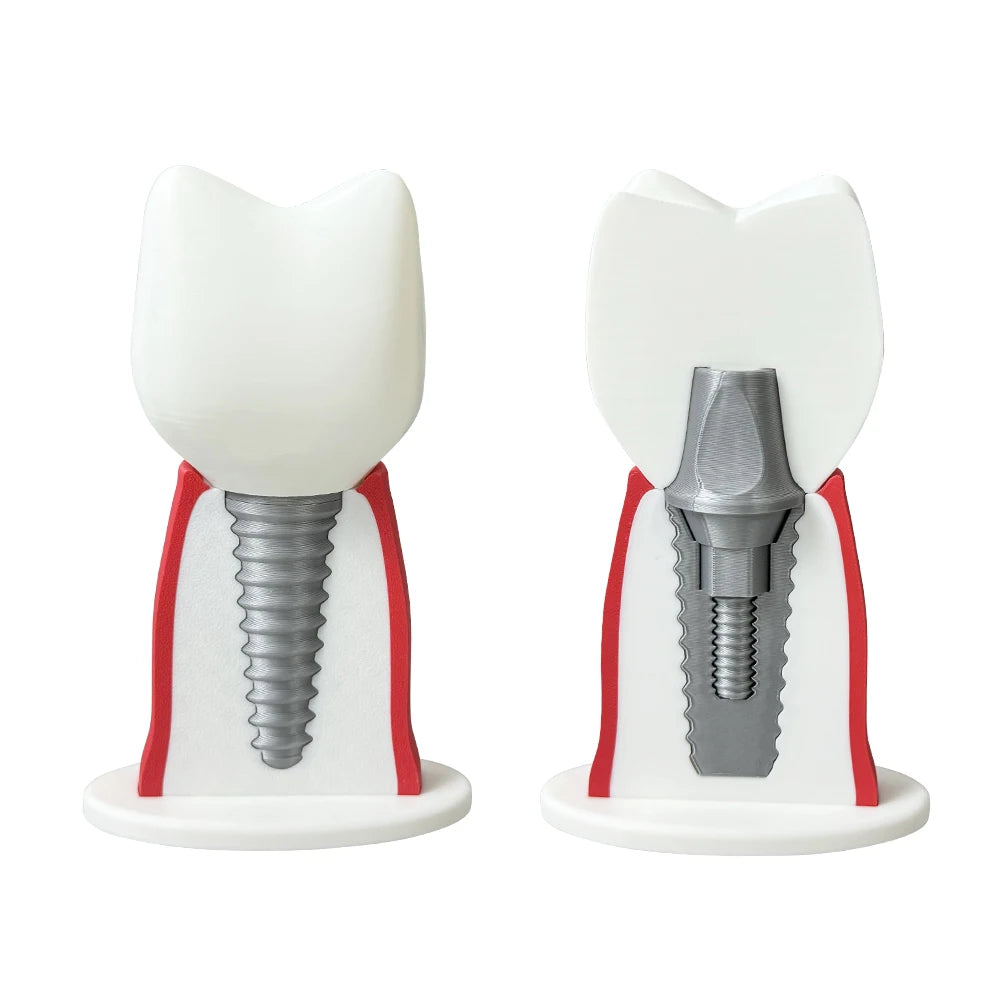 Detachable Implant Demonstration Model (Large)