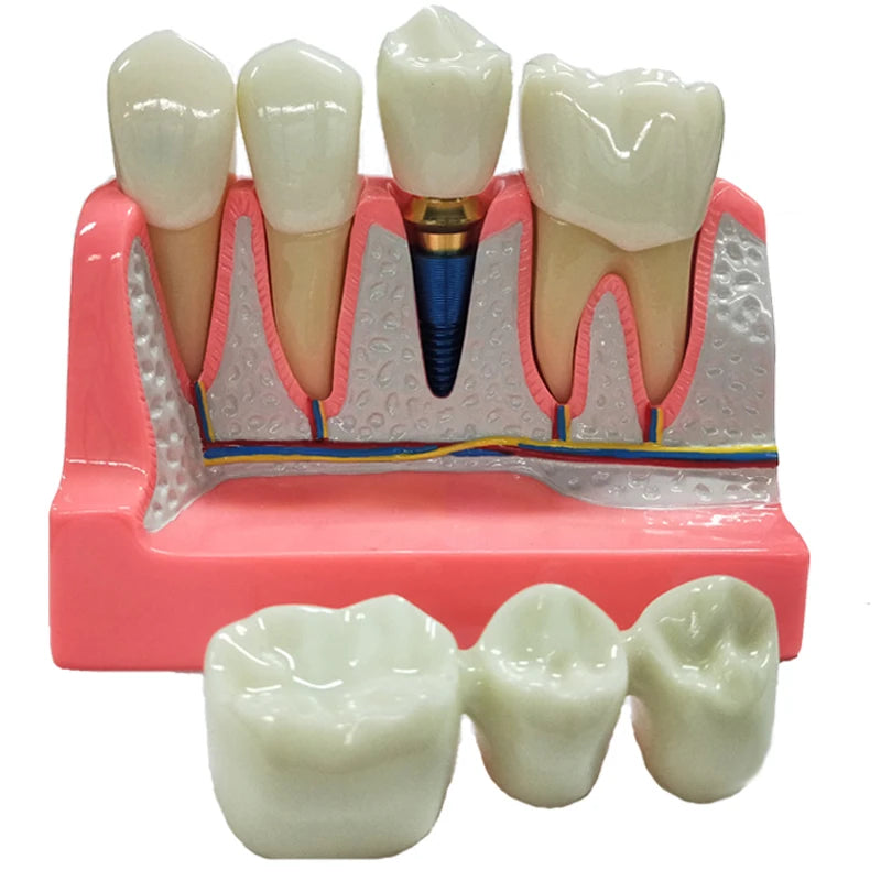 Magnified Caries & Implant Demonstration Model