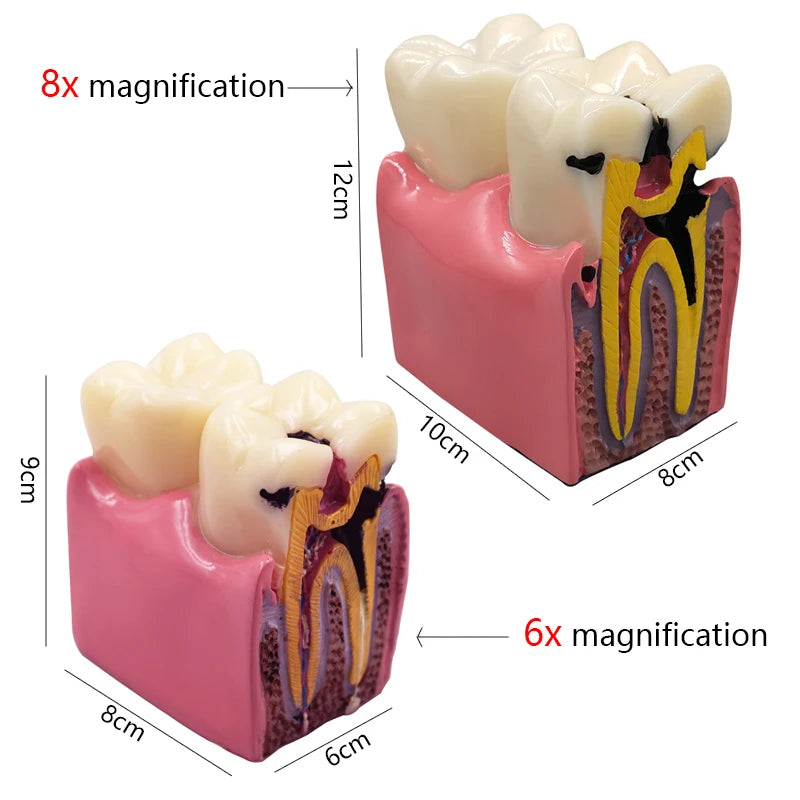 Magnified Caries & Implant Demonstration Model