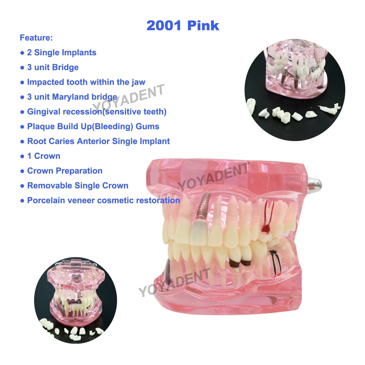 Restorative & Implant Pathology Model